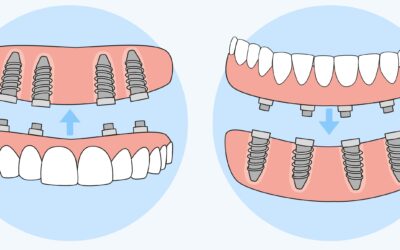 Riabilitazione completa dell’arcata dentale con impianti
