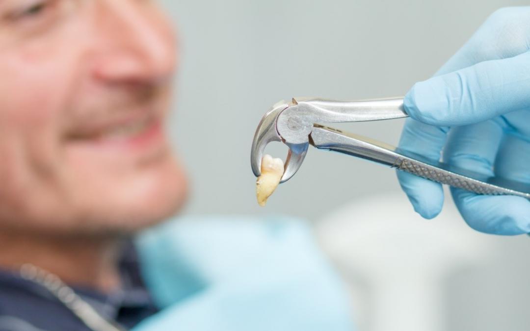 Estrazione dente del giudizio anestesia totale