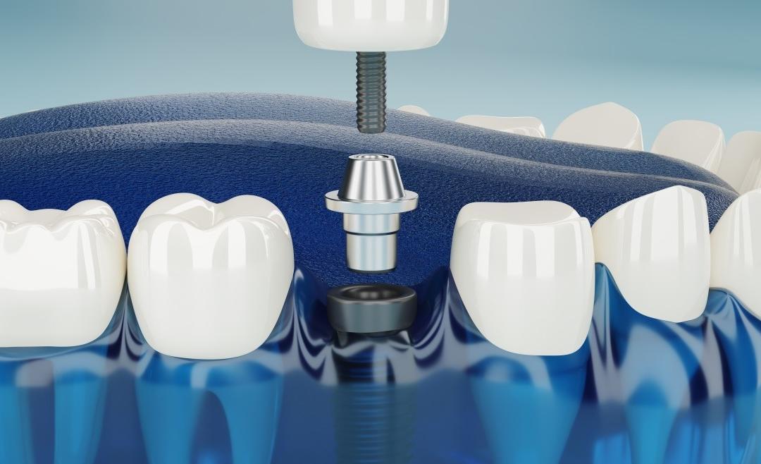 Protesi Dentale Fissa: come avere denti nuovi e fissi in 24 ore?