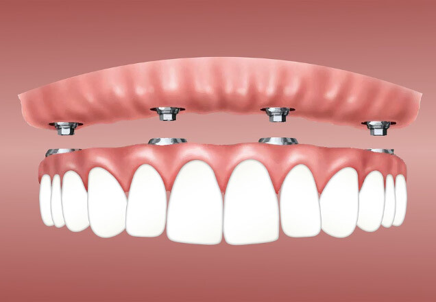 Implantologia dentale all-on-4