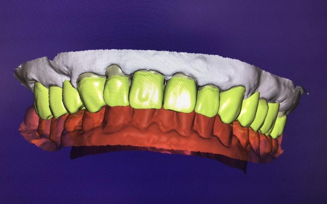Denti nuovi in 1 solo giorno - Denti fissi Roma
