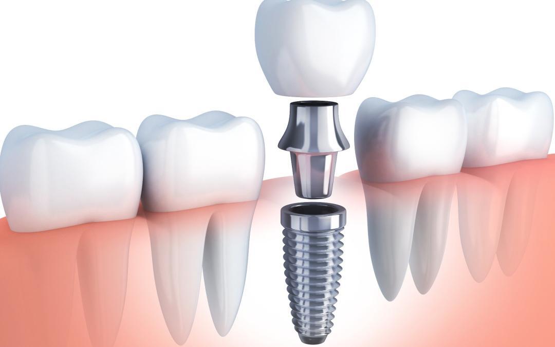 Impianti dentali controindicazioni