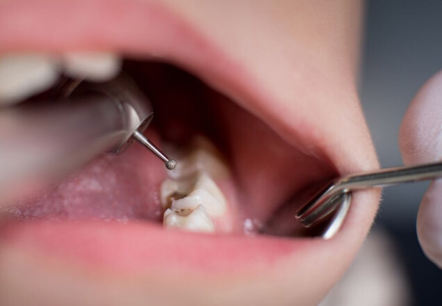 Superare paura trapano dentista