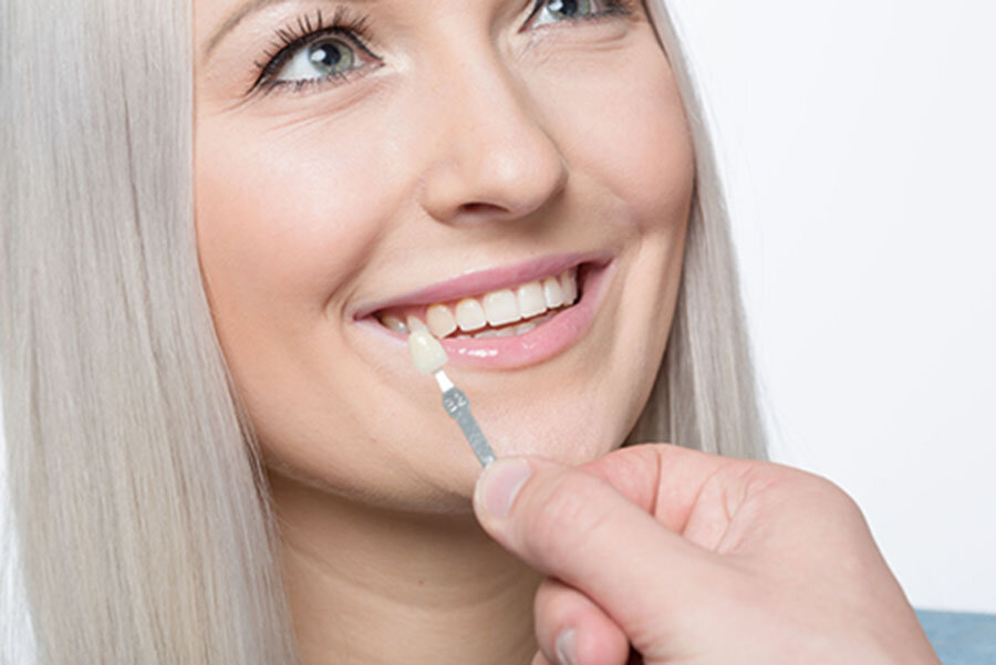 Faccette dentali: così torna il sorriso