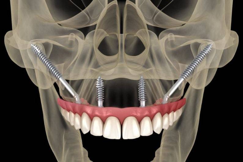 Impianti dentali senza osso