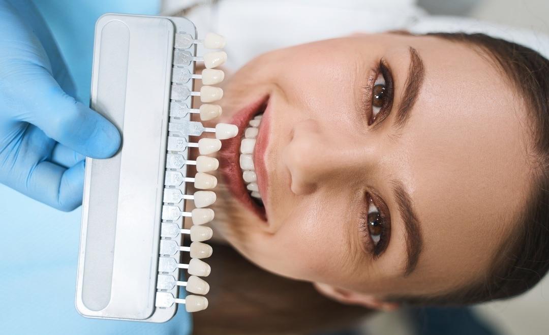 Faccette dentali: cosa sono, quando utilizzarle e benefici
