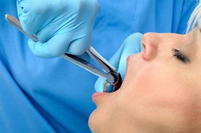 Estrazione dei denti e anestesia totale a Roma