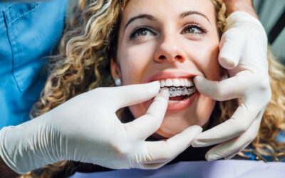Allineare e raddrizzare i denti da adulto è possibile?