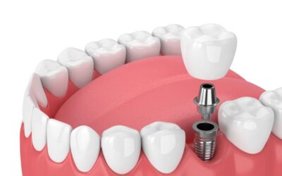 Denti fissi low cost: è possibile avere i denti fissi in 1 giorno a basso costo?