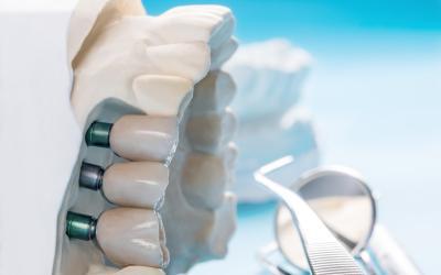 Impianti Dentali Roma AXA: una soluzione moderna per la perdita dei denti