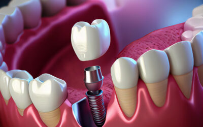 Implantologia a Ostia senza dolore: nello Studio Dentistico del Prof. Livio Gallottini
