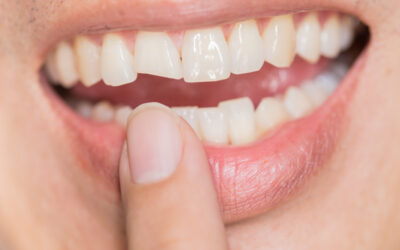 Ricostruzione dente spezzato o scheggiato: dentista vicino Ostia Lido e Ostia Antica